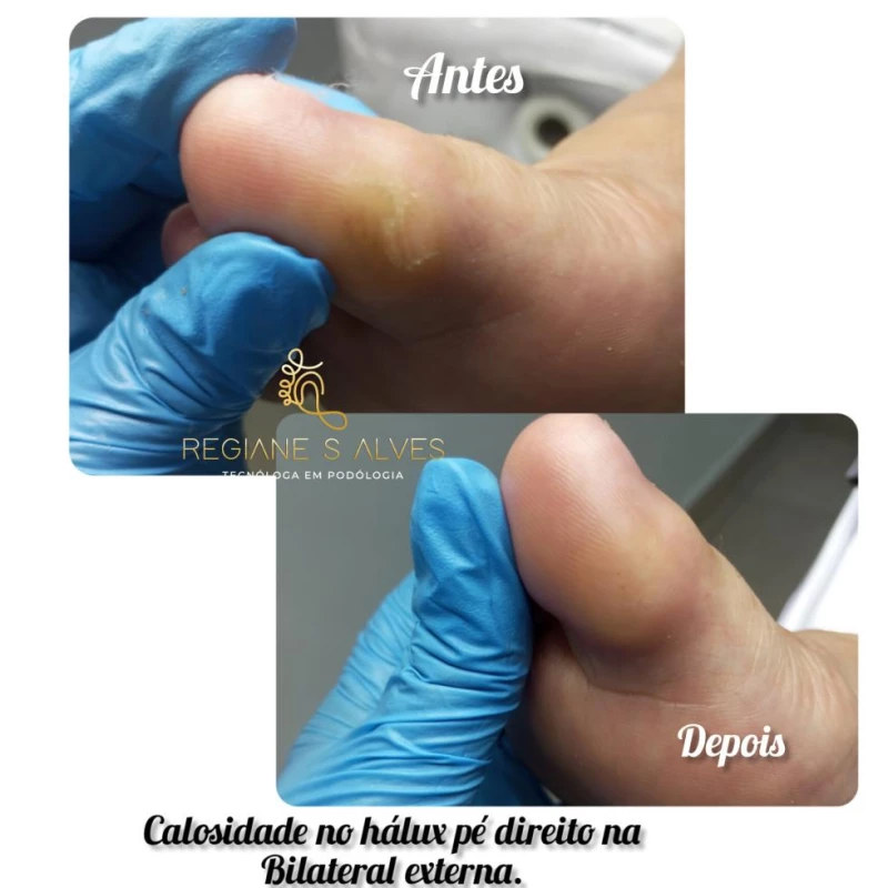 Calos, calosidade, hiperqueratose e queratose