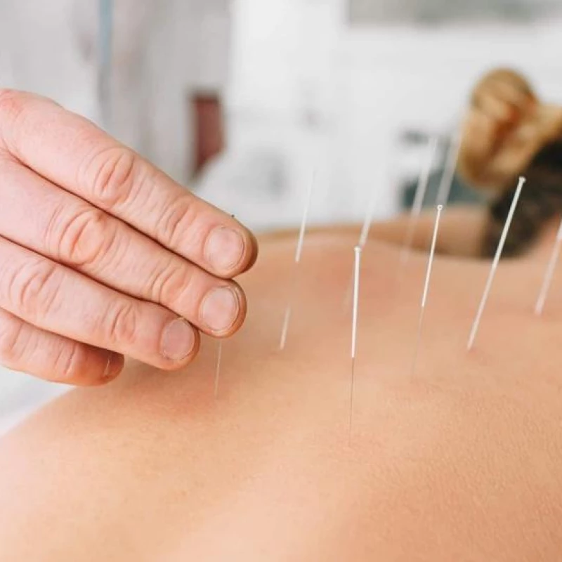 Acupuntura
