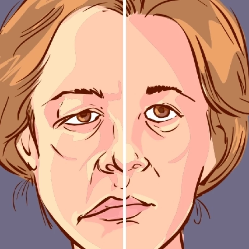 Fisioterapia na Paralisia Facial