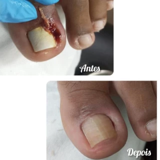 Onicocriptose  c/ infecção é s/infecção 