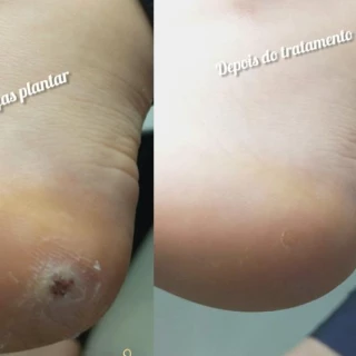 Tratamento verrugas plantar (olho de peixe)