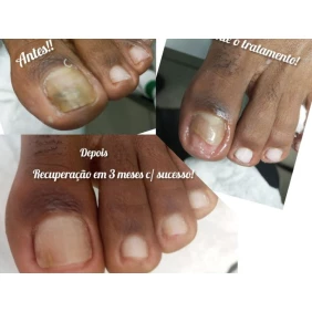 Foto Tratamento de onicomicose 