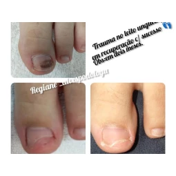 Foto Traumas sobre o leito ungueal 