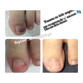 Foto Traumas sobre o leito ungueal 
