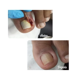 Foto Onicocriptose  c/ infecção é s/infecção 