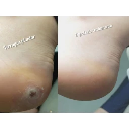 Foto Tratamento verrugas plantar (olho de peixe)