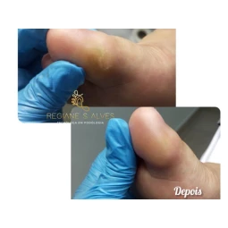 Foto Calos, calosidade, hiperqueratose e queratose