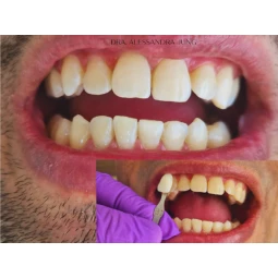 Foto Clareamento Dental