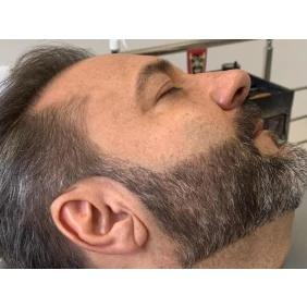 Foto Full Barba (Micropigmentação de Barba)