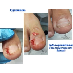 Foto Unha encravada onicocriptose infeccionada 