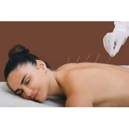 Foto Acupuntura