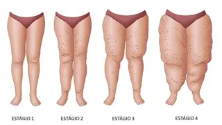 Lipedema ou só uma Celulite?