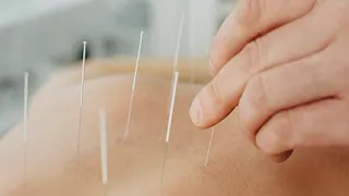 Acupuntura e seus incríveis benefícios para sua saúde.