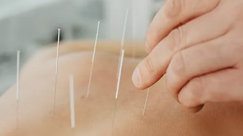 Acupuntura e seus incríveis benefícios para sua saúde.