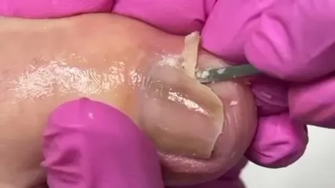 Procedimento de onicrocriptose s/infecção 