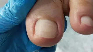 Podoprofilaxia+onicotomia c/ sucesso....????????????????