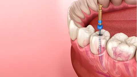 Tratamento de canal: quando ele é necessário e como ajuda a salvar seu dente