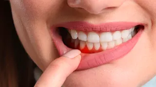 Periodontia: entenda as doenças da gengiva e como preveni-las