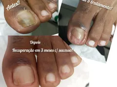 Tratamento de onicomicose 