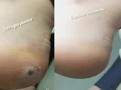 Tratamento verrugas plantar (olho de peixe)