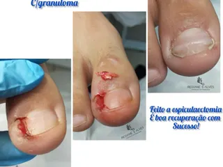 Unha encravada onicocriptose infeccionada 