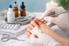 Tratamento para Unha Encravada (Onicocriptose) Inflamada