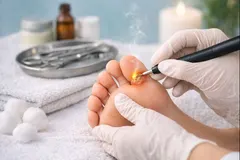 Tratamento para Verruga Plantar (Olho de Peixe)
