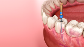 Foto: Tratamento de canal: quando ele é necessário e como ajuda a salvar seu dente