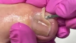 Procedimento de onicrocriptose s/infecção 