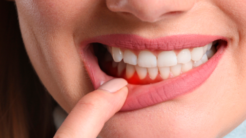 Periodontia: entenda as doenças da gengiva e como preveni-las