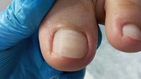 Foto: Podoprofilaxia+onicotomia c/ sucesso....????????????????