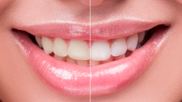 Entenda o processo do clareamento dental e os cuidados necessários