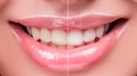 Foto: Entenda o processo do clareamento dental e os cuidados necessários