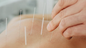 Foto: Acupuntura e seus incríveis benefícios para sua saúde.