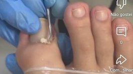 (Onicofose) ou seja peles que tanto encomoda 