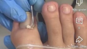 Foto: (Onicofose) ou seja peles que tanto encomoda 