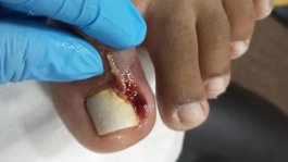 Procedimento de onicrocriptose com infecção 