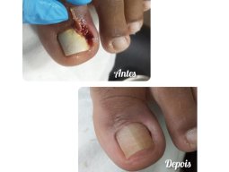 Foto Onicocriptose  c/ infecção é s/infecção 